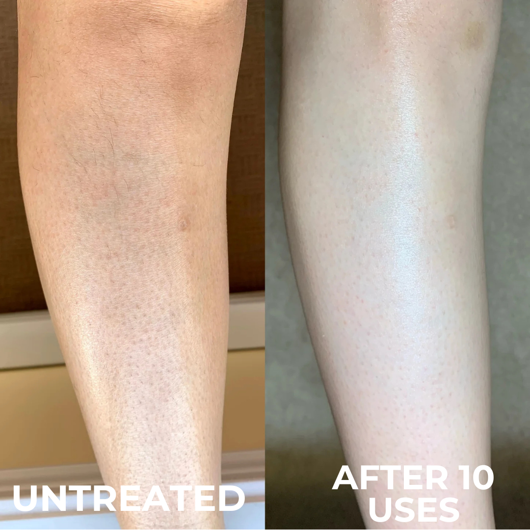 Advanced Triple-Acid Complex for Keratosis Pilaris