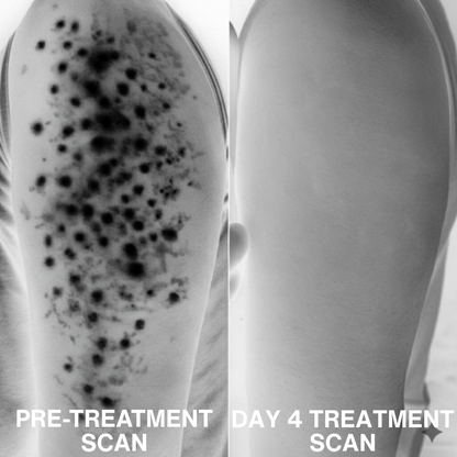 Advanced Triple-Acid Complex for Keratosis Pilaris